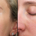 Anti-aging Treatments: An In-depth Look