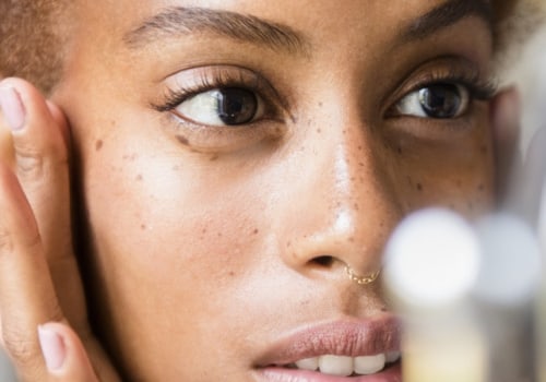 Acne Treatment: A Comprehensive Overview